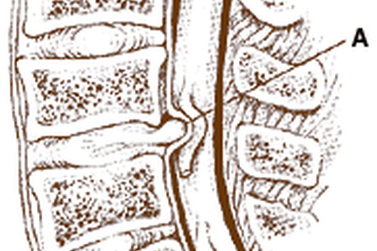 Protrusión discal.