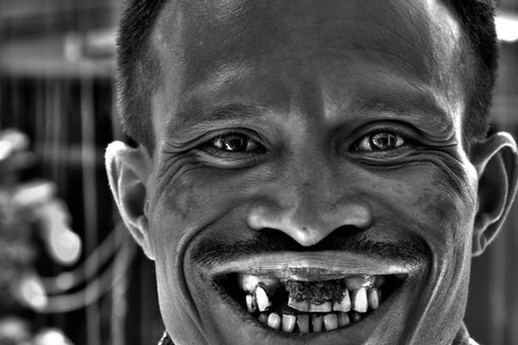 Los implantes dentales se usan para rellenar espacios, jugando un rol funcional y cosmético.