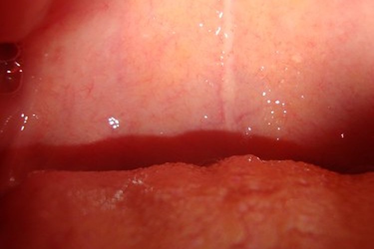 Las infecciones de faringitis estreptocócica son más comunes en jóvenes de entre 5 y 15 años de edad, pero la infección puede afectar a personas de todas las edades.