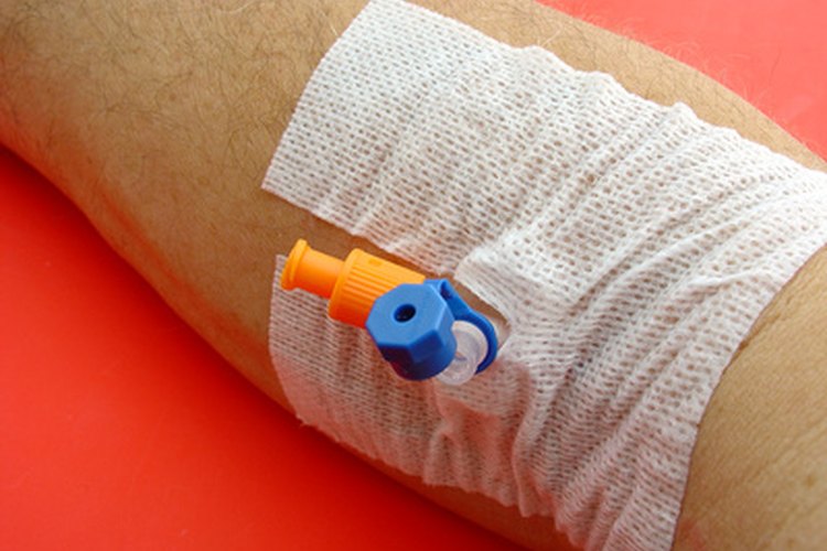 Una vena reventada puede ocurrir como consecuencia de una IV.