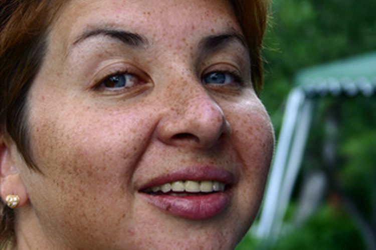 Las pecas pueden ser lindas, pero las manchas grandes pueden ser desagradables.
