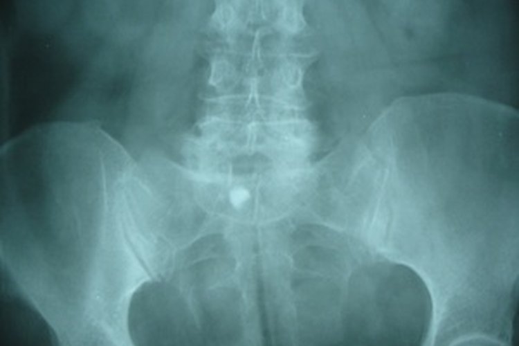 Cálculo renal.