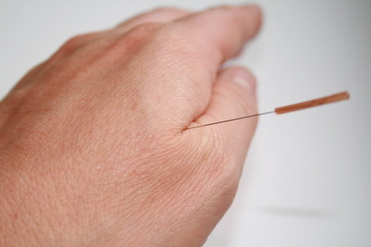 La acupuntura puede ser una alternativa para tratar los síntomas del herpes zóster.