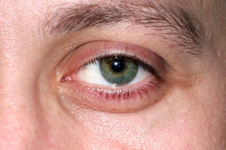 Los ojos normales tienen una forma esférica.