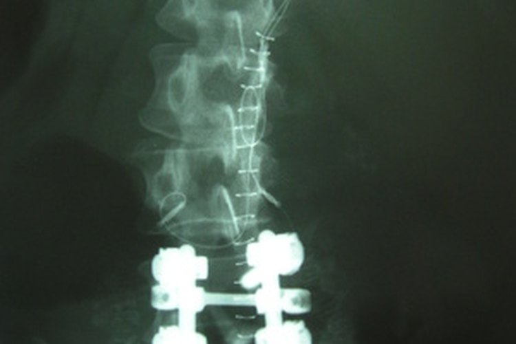 Existen métodos eficaces para aliviar el dolor de cuello de nervios pinzados.