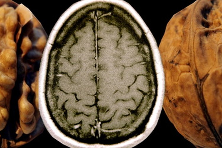 La esquizofrenia es un trastorno complejo del cerebro.