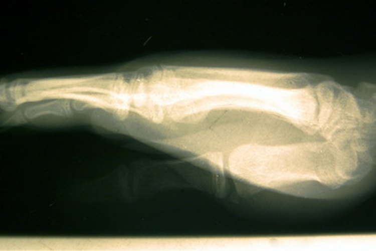 Hay nuevas técnicas muy prometedoras para la cura de fracturas.
