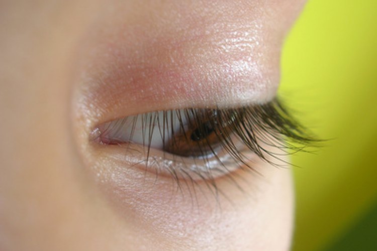 La migraña oftalmopléjica provoca parálisis temporal de los músculos del ojo.