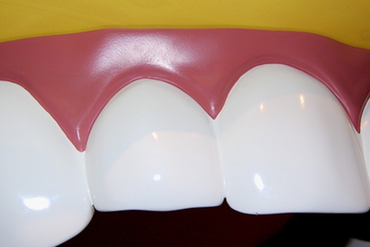 Una férula oclusal es usada en el tratamiento del rechinido de dientes.