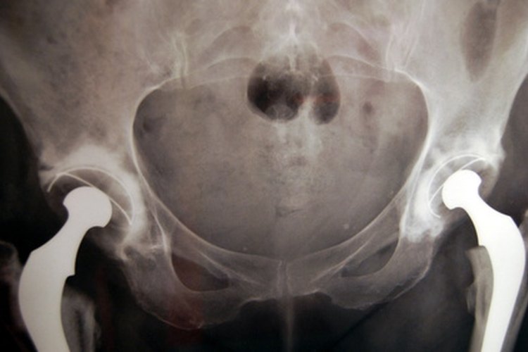 Una pelvis fracturada es una lesión muy seria.