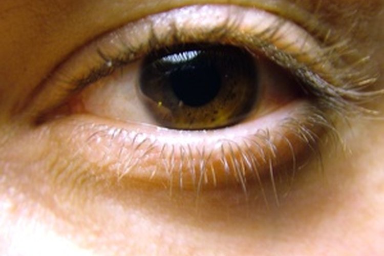 En las etapas avanzadas de la cirrosis lo blanco de los ojos puede tornarse amarillento.