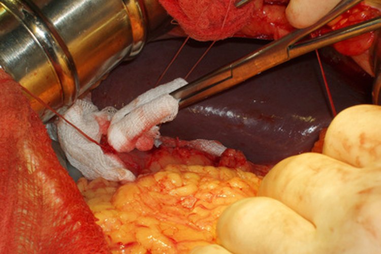 La dehiscencia completa de una herida abdominal puede exponer a los órganos internos.