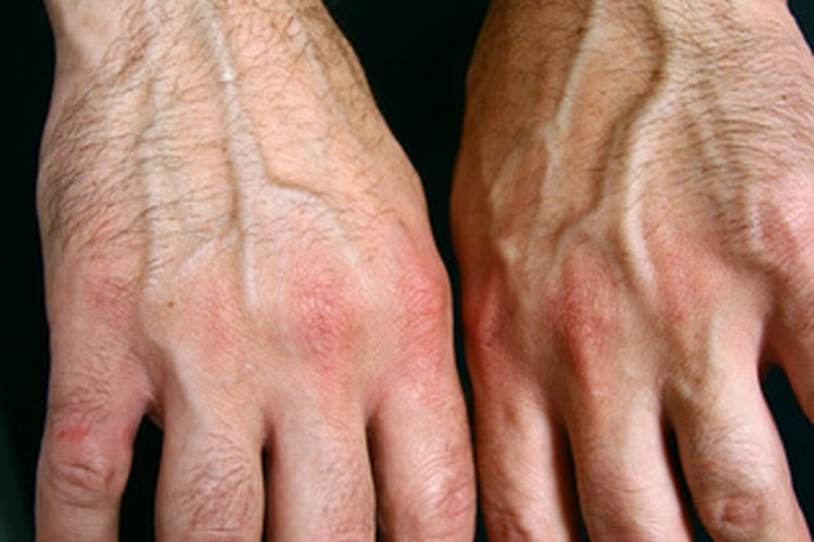 La artritis reumatoide, una enfermedad autoinmune localizada, es más común en las articulaciones de las manos.