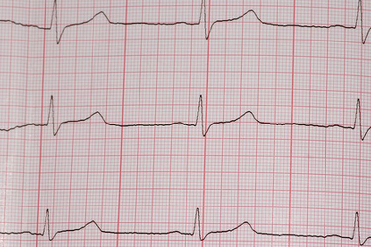 Un electrocardiograma.