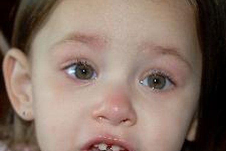 El virus del herpes también puede atacar a los niños.