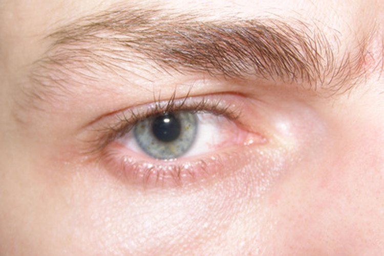 El ojo seco puede causar enrojecimiento e irritación.