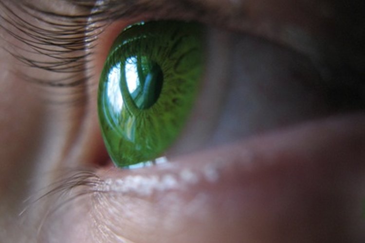 Las lentes de contacto pueden introducir y atrapar bacteria en los ojos, que puede causar cnjuntivitis.