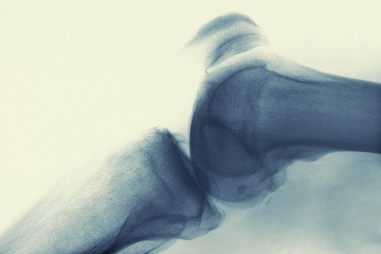La enfermedad de Lyme puede causar síntomas similares a la artritis y otras complicaciones.