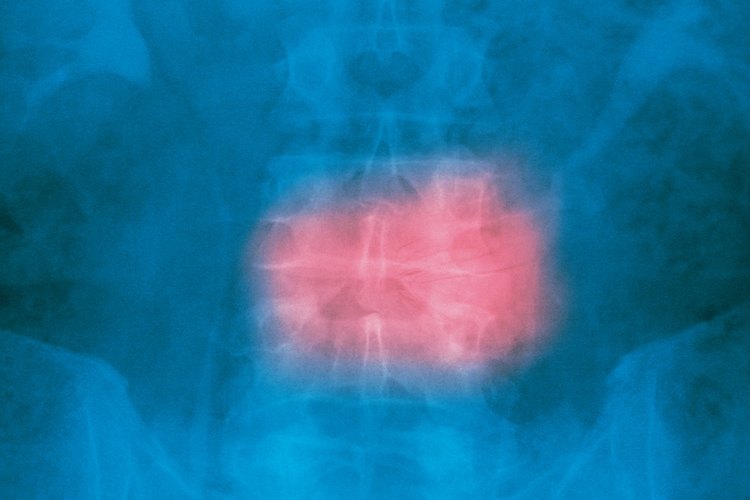 La compresión de la columna vertebral produce molestias.