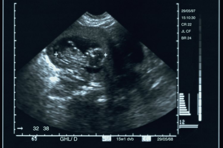 Imagen de ultrasonido de un feto humano.