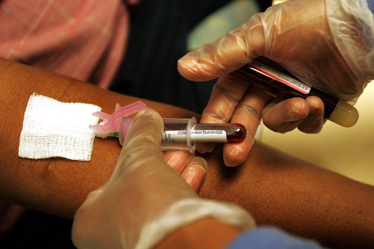 La orina de color rojo es un síntoma de altos niveles de proteínas.