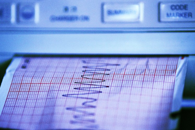 Con frecuencia, la insuficiencia cardíaca y los ritmos cardíacos anormales coexisten.