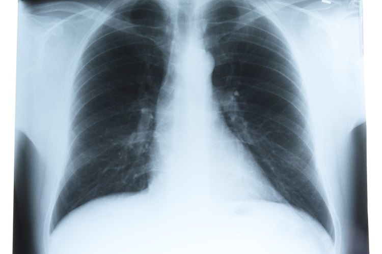 Una lesión en los pulmones necesita ser tratada rápidamente.