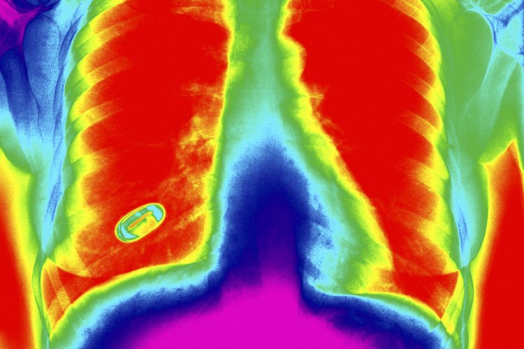 Enfermedades pulmonares intersticiales.