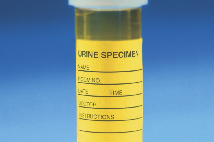 El análisis de la muestra de orina puede detectar la proteína en la orina.