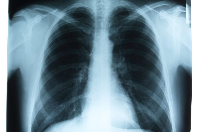 La bronquitis aguda puede causar dificultad para respirar.