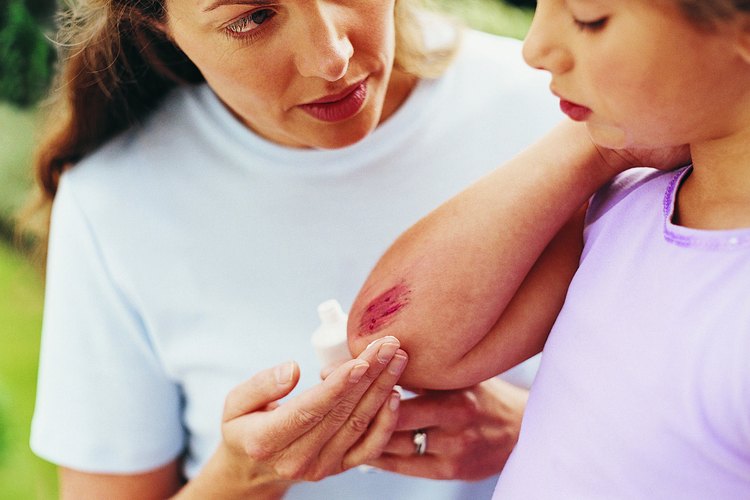 Algunas inflamaciones son necesarias para sanar las heridas, pero el aceite de coco puede aliviar los síntomas de la inflamación.