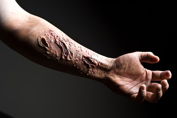 Los queloides también pueden estar potencialmente infectados, lo que podría suponer un grave riesgo para la salud, y generalmente requieren cirugía.