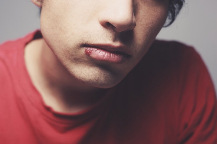 Fever blister
