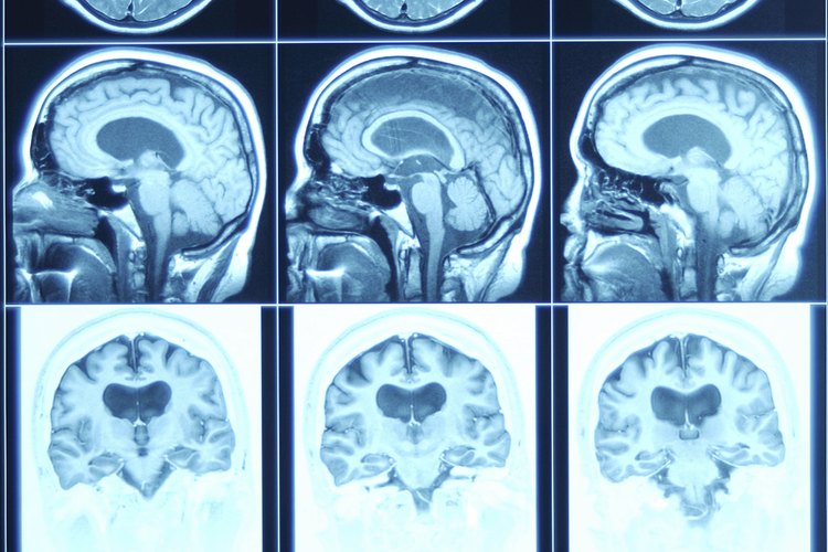 El cáncer cerebral es detectado cada vez con más frecuencia.