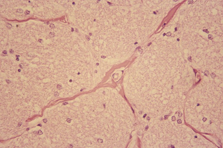 La neuropatía periférica es una condición incómoda y usualmente dolorosa.