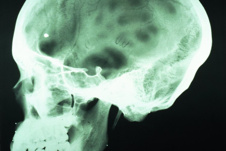 Los síntomas de una conmoción cerebral pueden retrasarse durante semanas o más tiempo.