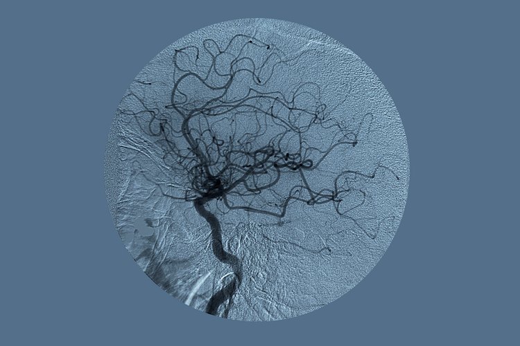 Se utilizan unos rayos x especiales para buscar algún bloqueo en las arterias del cuello.