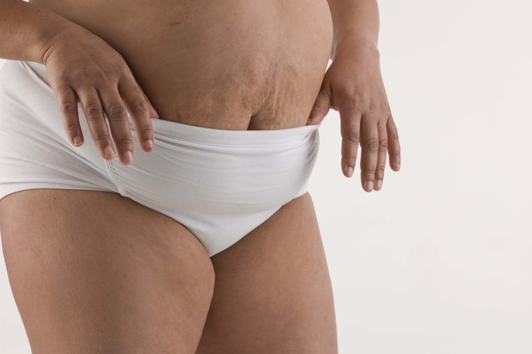 La grasa en la parte inferior del abdomen puede ser difícil de tratar.