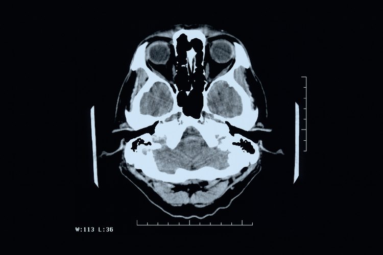 La norepinefrina es la sustancia química del cerebro asociada con el pánico, el miedo y otros estados emocionales exacerbados.