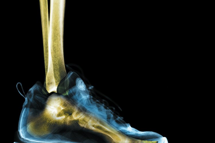 El calzado con poco soporte puede llevar a dolorosos espolones óseos y fascitis plantar.