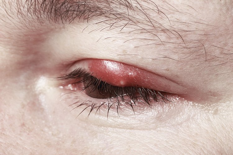 Una forma de queratosis, llamada queratosis seborreica, puede formar un tumor no canceroso en tu párpado. Inicialmente, la queratosis seborreica aparece como bultos diminutos y ásperos en tu piel.