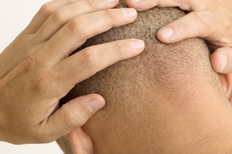 El cabello ralo en los hombres se presenta cuando el diámetro del folículo del pelo comienza a encogerse.