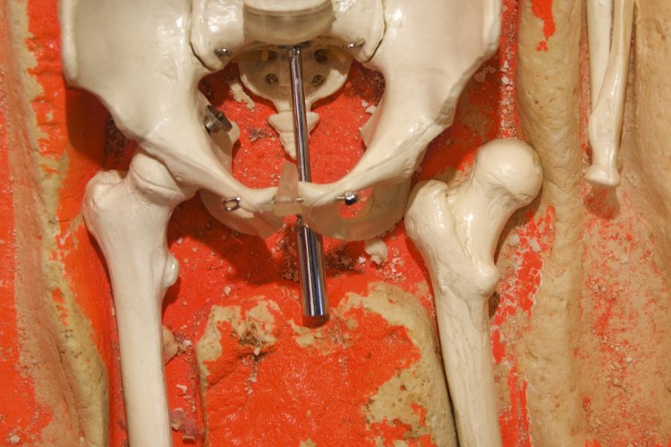 La bursitis Ilio-femoral causa dolor e inflamación en la articulación de la cadera.