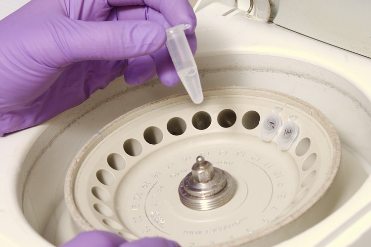 Un recuento bajo de plaquetas en sangre indica la presencia de trombocitopenia.