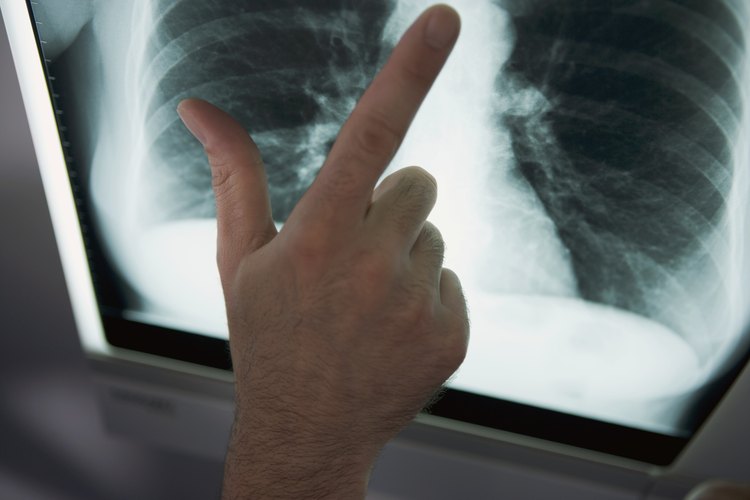 Los pulmones sanos llevan oxígeno al cuerpo y permiten la respiración normal.