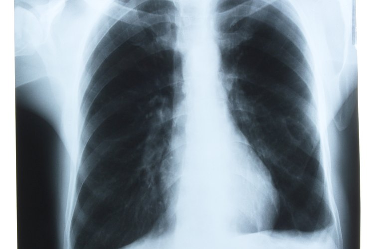 La destrucción alveolar es el sello del enfisema.