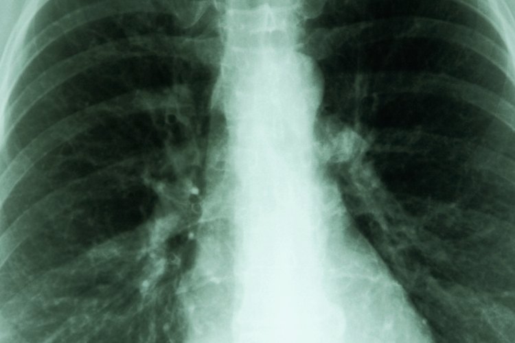 Radiografía pulmonar.