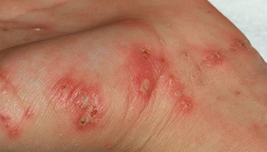 scabies on the hand scabies on the hand