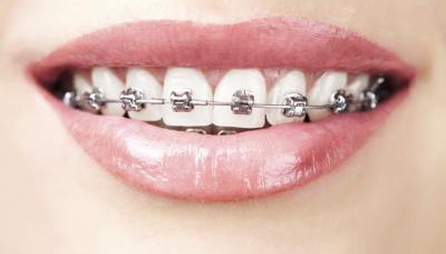 Stainless steel items such as dental braces can distort MRI images. Stainless steel items such as dental braces can distort MRI images.