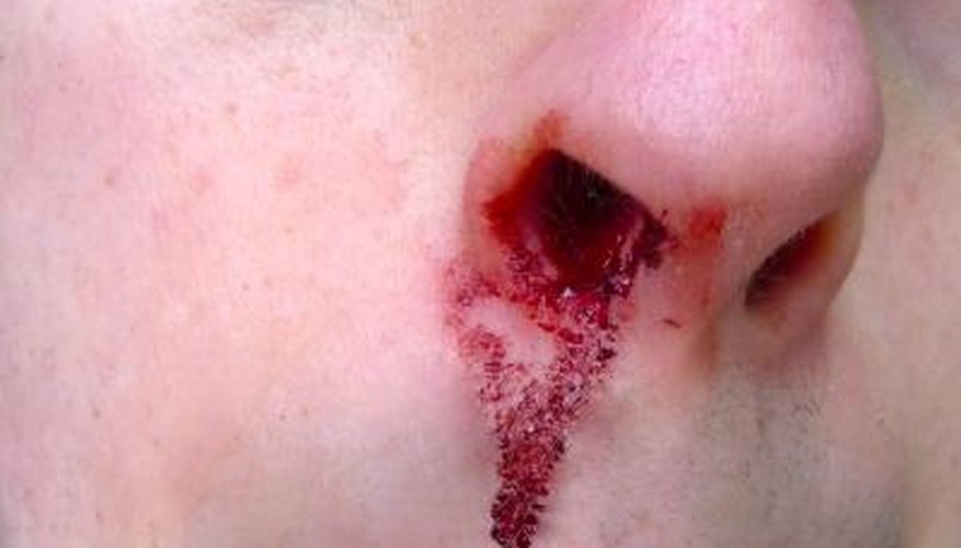 Treating nosebleeds for infants is simple. Treating nosebleeds for infants is simple.